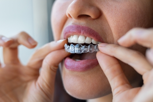 Invisalign, Zahnschiene, Dr. Smile, Aligner